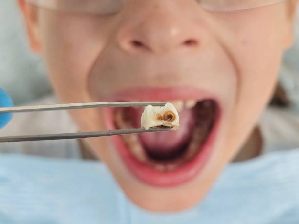 Best Emergency Broken Tooth Repair in Southeast Arcadia, FL